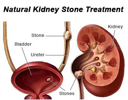 Kidney Stone Treatment